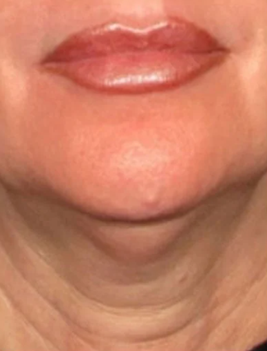 Anonymous Before