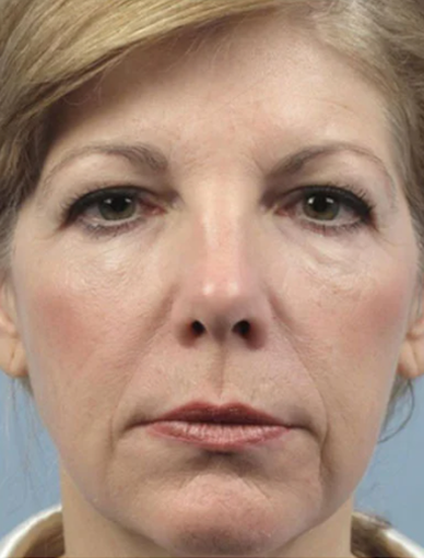 Anonymous Before