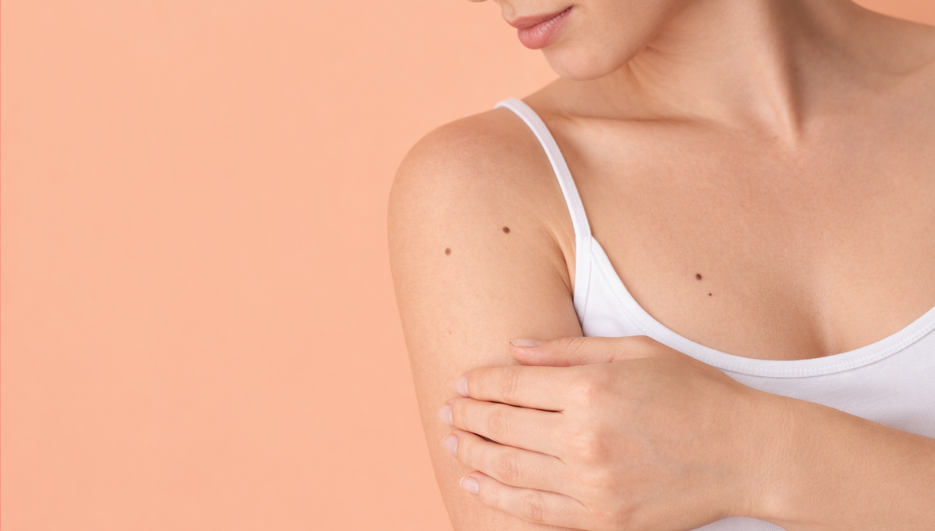 What You Need to Know About Moles in Your Areola
