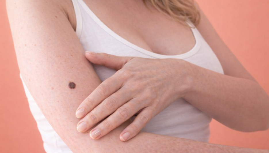 How Fast Melanoma Grows?