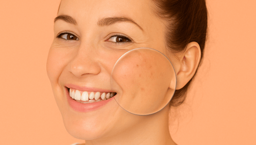 Can Microneedling Cause Acne? Expert Insights to Consider Before Treatment