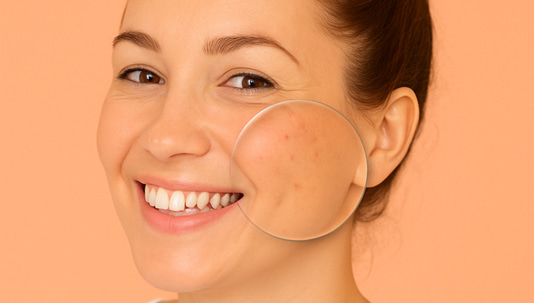 Can Microneedling Cause Acne? Expert Insights to Consider Before Treatment