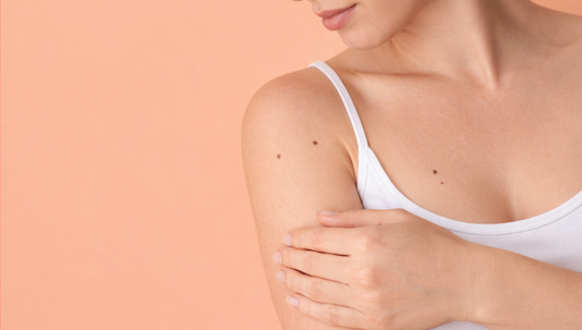 What You Need to Know About Moles in Your Areola