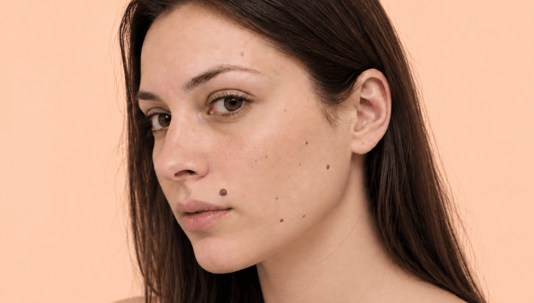 Everything You’ll Need To Know About Skin Tags and Insulin Resistance