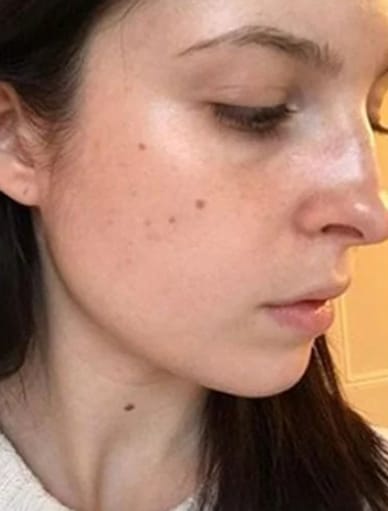 Spot Injection London Harley Street Free Consultation