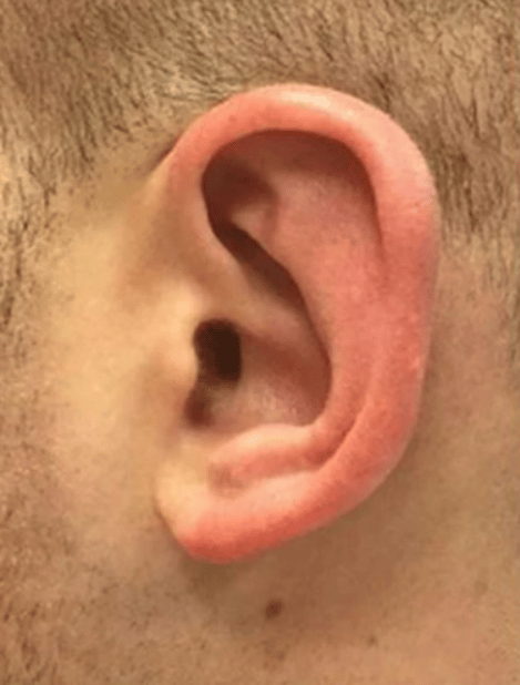 Otoplasty London Harley Street Free Consultation