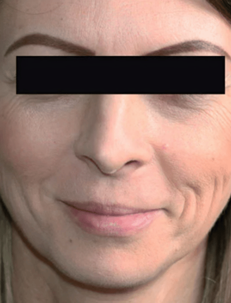 can i take glutathione after rhinoplasty The Dark Truth About Glutathione & Skin Whitening – Risks, Myths & Facts main image 0