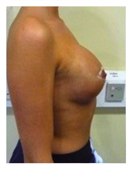 Fat Transfer to Breasts After