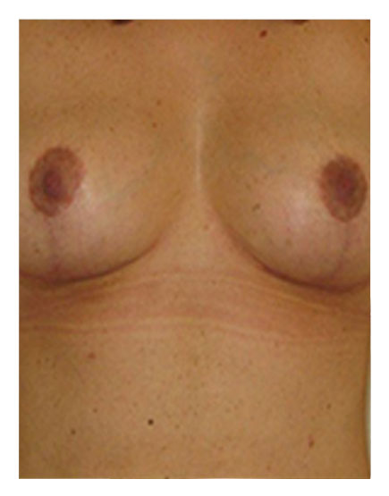 Breast Uplift After