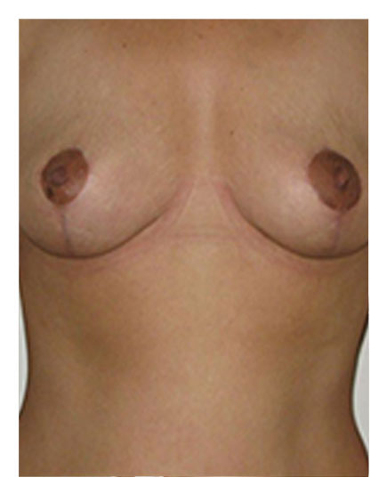 Breast Uplift After