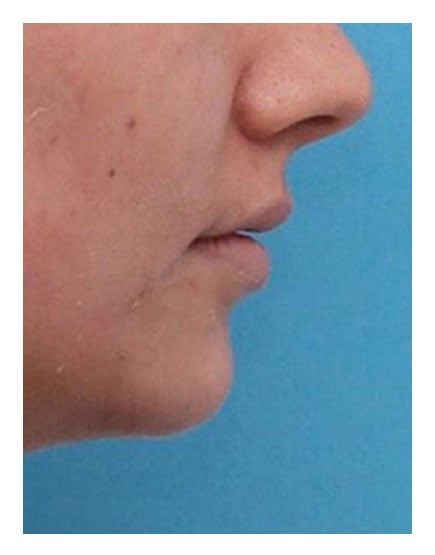 Chin Alteration After