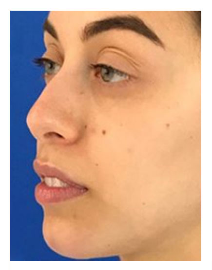 Chin Augmentation After