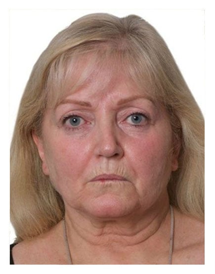 Surgical Facelift Before