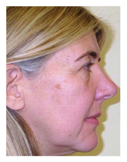 Lower Face and Neck Lift Before