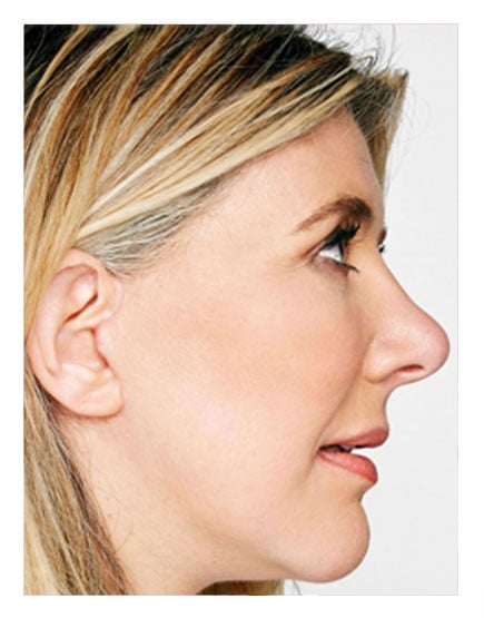 Lower Face and Neck Lift After