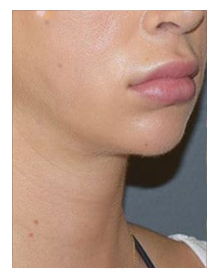Vaser Lipsuction After