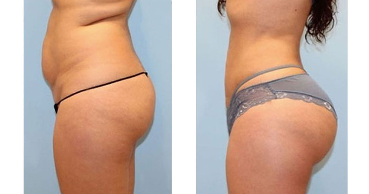 Fat Transfer Before and After